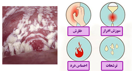 قرص و کرم واژینال کلوتریمازول برای درمان عفونت واژن